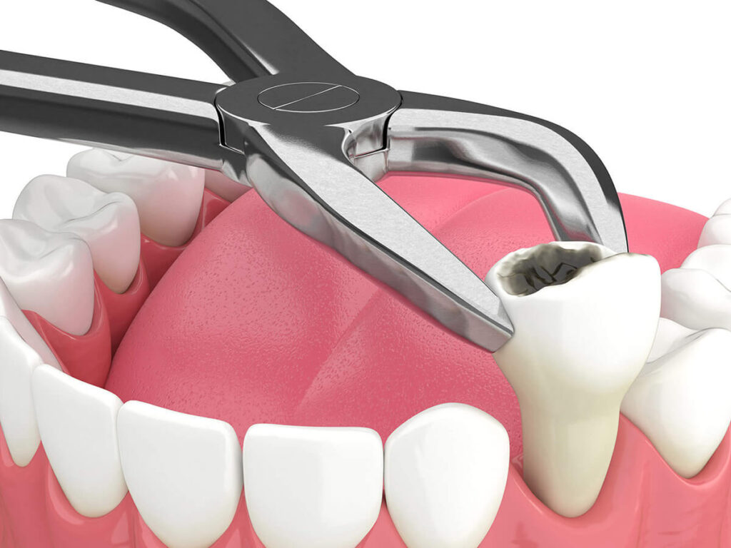 3D illustration of extracting a tooth with a cavity