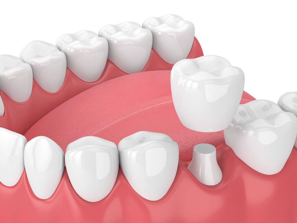 3D illustration of a dental crown and bridges