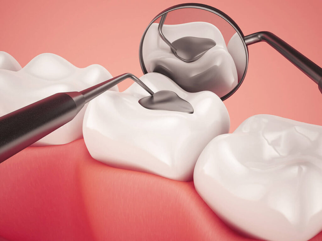 3D illustration of dental fillings and sealants