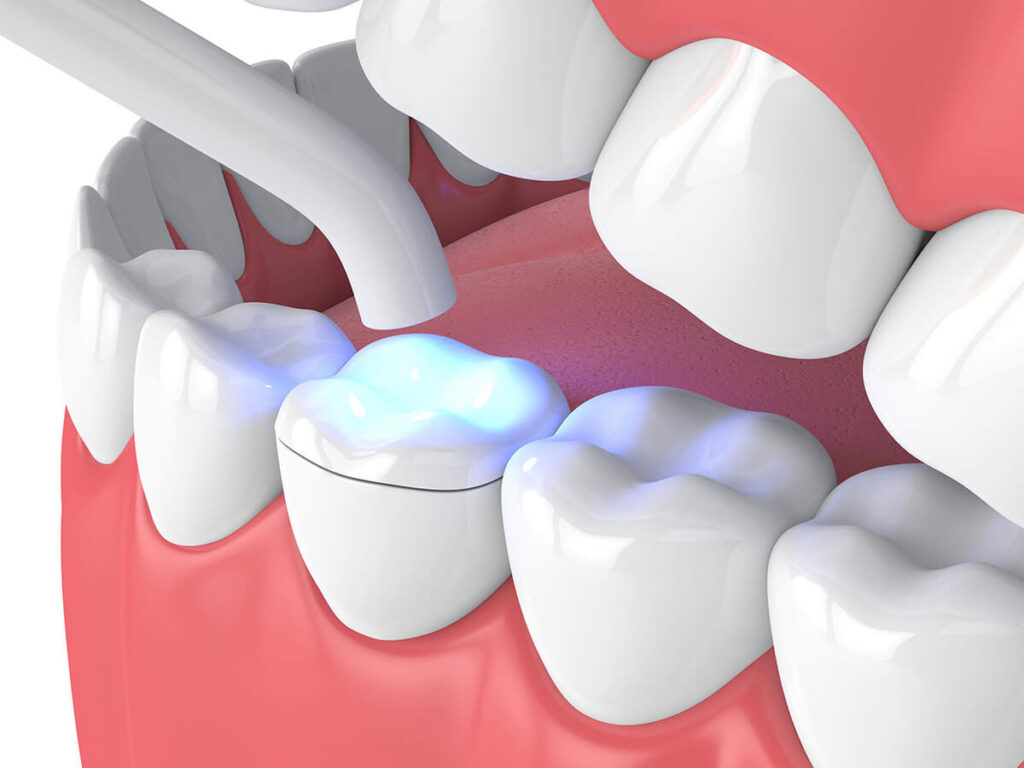 3D illustration of a dental onlay and inlay