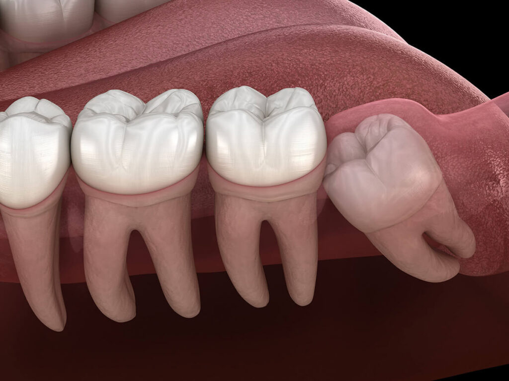 3D illustration of n impacted wisdom tooth
